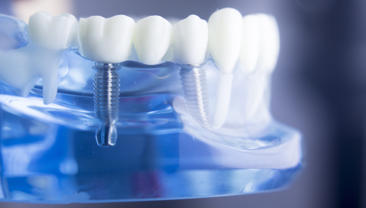 Dental model showing teeth, roots and the gum line